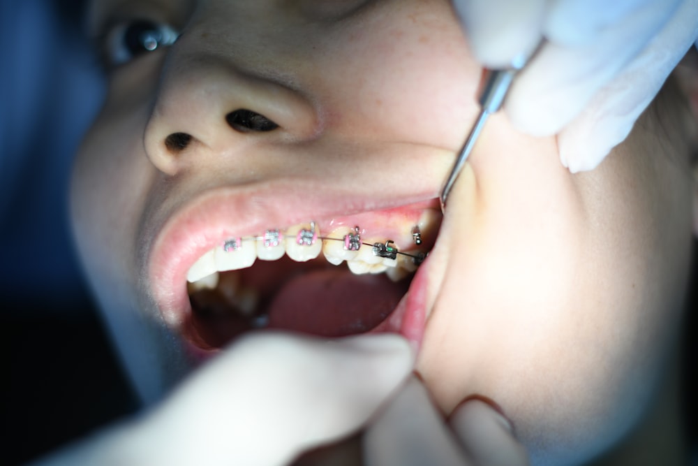 Close-up of orthodontic braces during a check-up